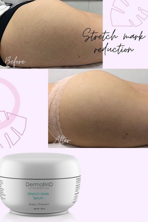 Dermal MD Reviews
-
https://dermalmd.com/product/stretch-mark-cream/

DermalMD Is a Groundbreaking treatment to get rid of stretch marks. It comes in a cream and serum form and is the only thing on the market today that Dermatologists suggest that work. DermalMD is The best stretch mark cream on the market today.