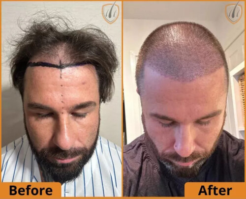 after hair transplant before after 768x622